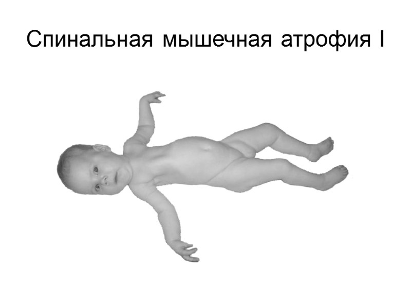 Спинальная мышечная атрофия I